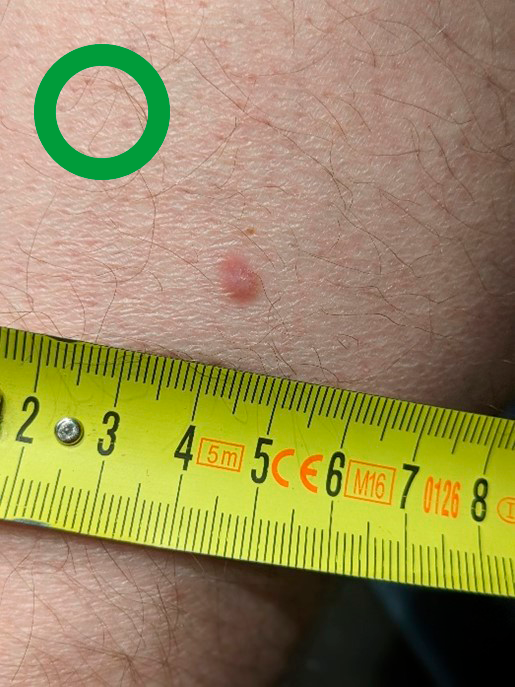 Photograph of mole on skin with a measuring tape next to it to denote size.
