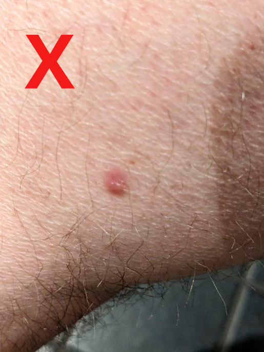 Picture of mole on calf with the focus on body hair. There is a red x at one side of the photograph to denote that the picture isn't successful.