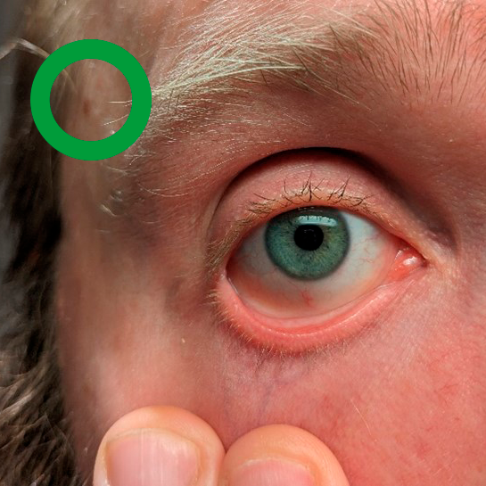 Photo showing part of a face. A person is stretching their lower eyelid so much that the downside of the lid is visible.